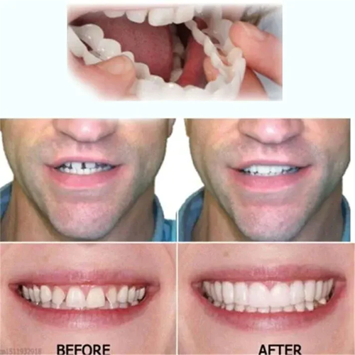 Oveallgo™ Adjustable 6Tech Snap-On Dentures